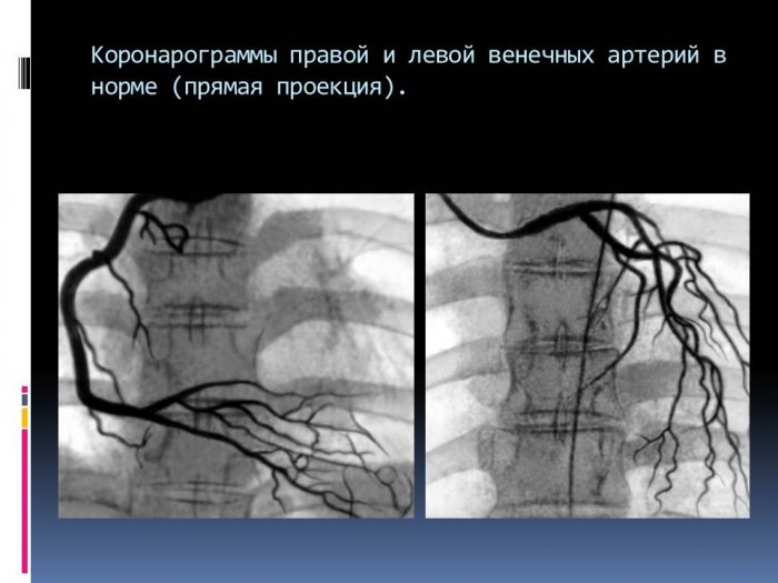 Презентация - Роль коронарографии, аортографии, вентрикулографии, компьютерной томографии сердца в диагностике коронарной недостаточности