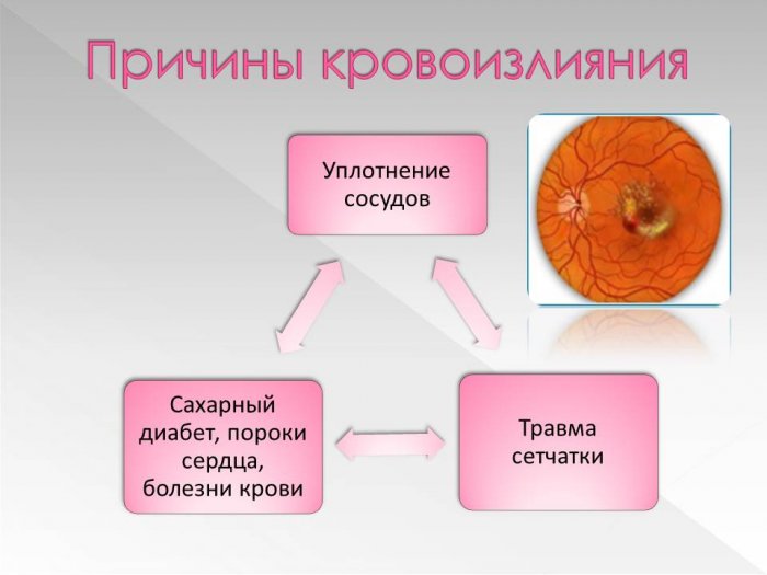 Презентация - Патология сетчатки