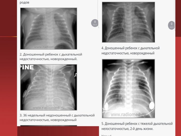 Презентация - Пневмопатии, синдром дыхательных расстройств (СДР)