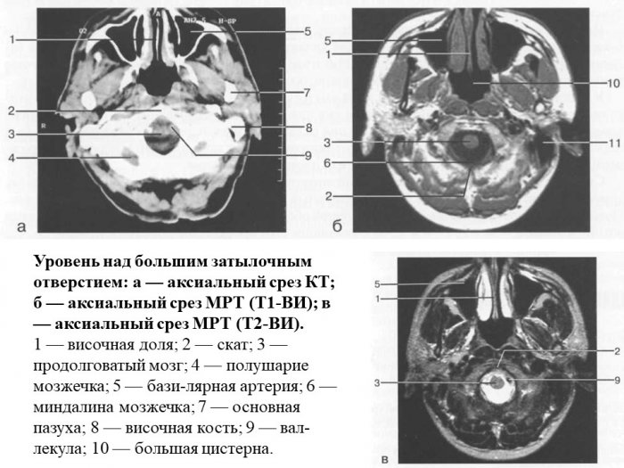 Презентация - Рентгеноанатомия структур головного и спинного мозга