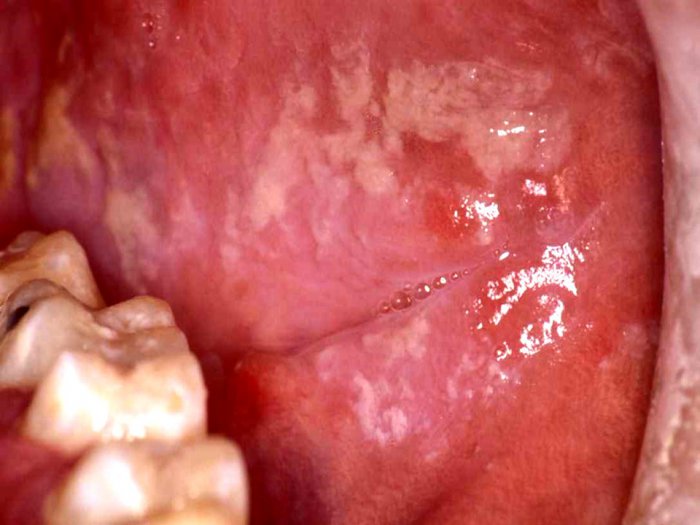 Презентация - Опухоли слюнных желез, губ, языка, мягких тканей и полости рта