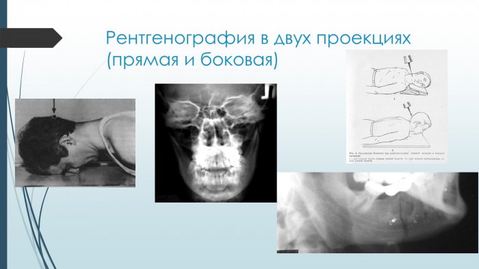 Презентация - Переломы нижней челюсти