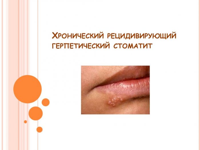 Презентация: Хронический рецидивирующий герпетический стоматит
