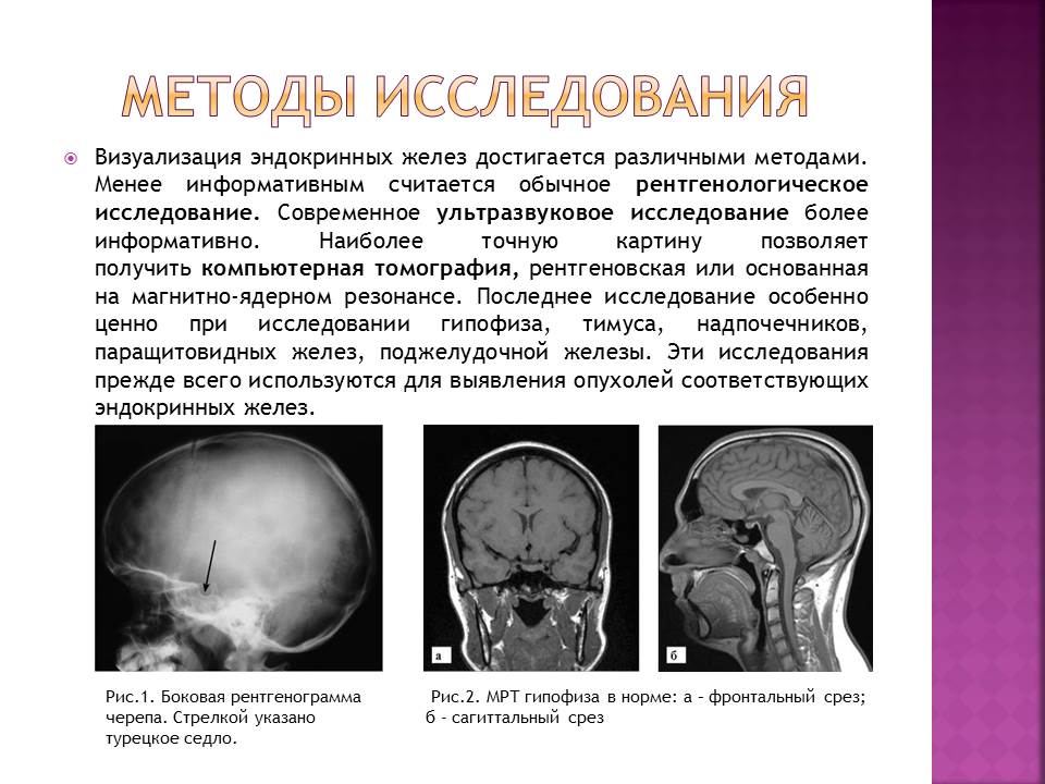Формирующееся турецкое седло в головном мозге. Аденома гипофиза рентген черепа. Лучевая диагностика турецкого седла. Синдром пустого турецкого седла кт. Анатомия турецкого седла рентген.