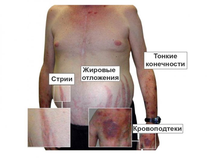 Презентация: Визуальная диагностика при гипоталамо-гипофизарном ожирении