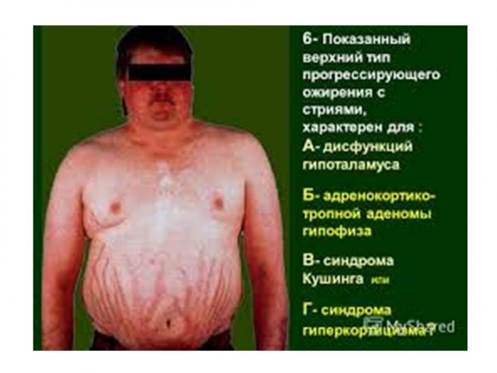 Презентация: Визуальная диагностика при гипоталамо-гипофизарном ожирении
