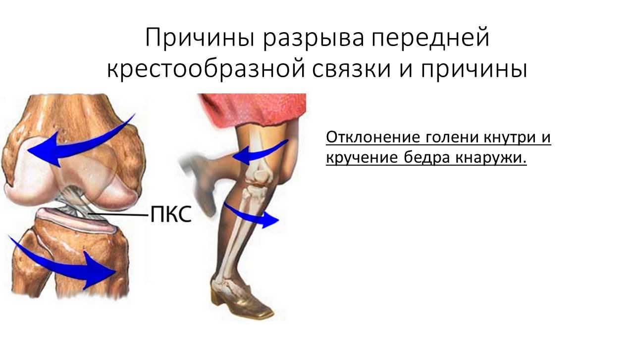 Разрыв назад. Повреждение крестообразных связок 1ст. Частичное повреждение волокон передней крестообразной связки колена. Разрыв передней крестообразной связки схема. Повреждение задней крестообразной связки механизм.