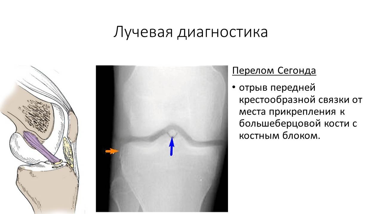 Мр признаки разрыва. Крестовидная связка коленного сустава травма. Разрыв передней крестообразной связки рентген. МР картина тотального разрыва передней крестообразной связки. Разрыв крестообразных связок рентген.