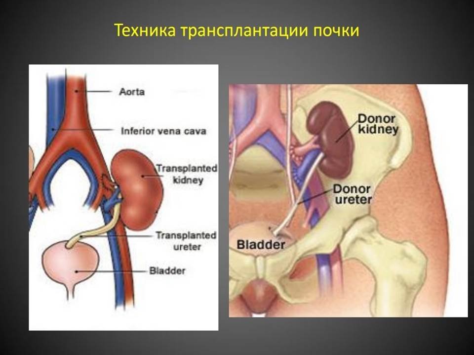 Схема операций трансплантации почки. Пересадка почки в россии