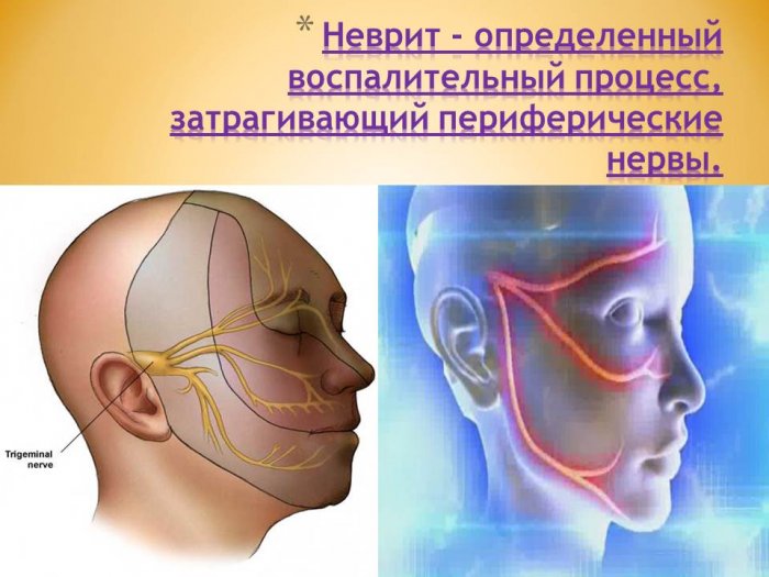 Презентация на тему: Заболевания нервов челюстно-лицевой области: невриты и невралгии тройничного нерва, ганглиониты