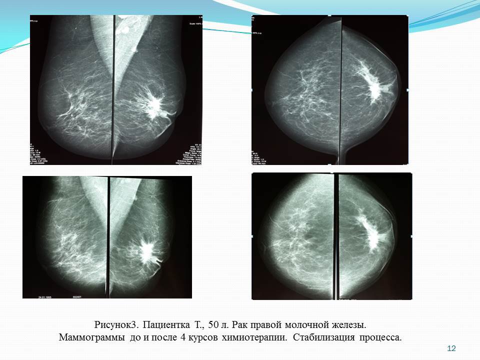 Рак молочной железы жизнь после. ЗНО молочной железы на маммографии. Маммография опухоль молочной железы. Опухоль на снимке маммографии.