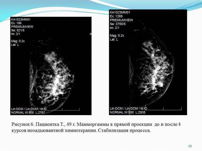 Презентация - Возможности маммографии в оценке эффективности неоадъювантной химиотерапии рака молочной железы