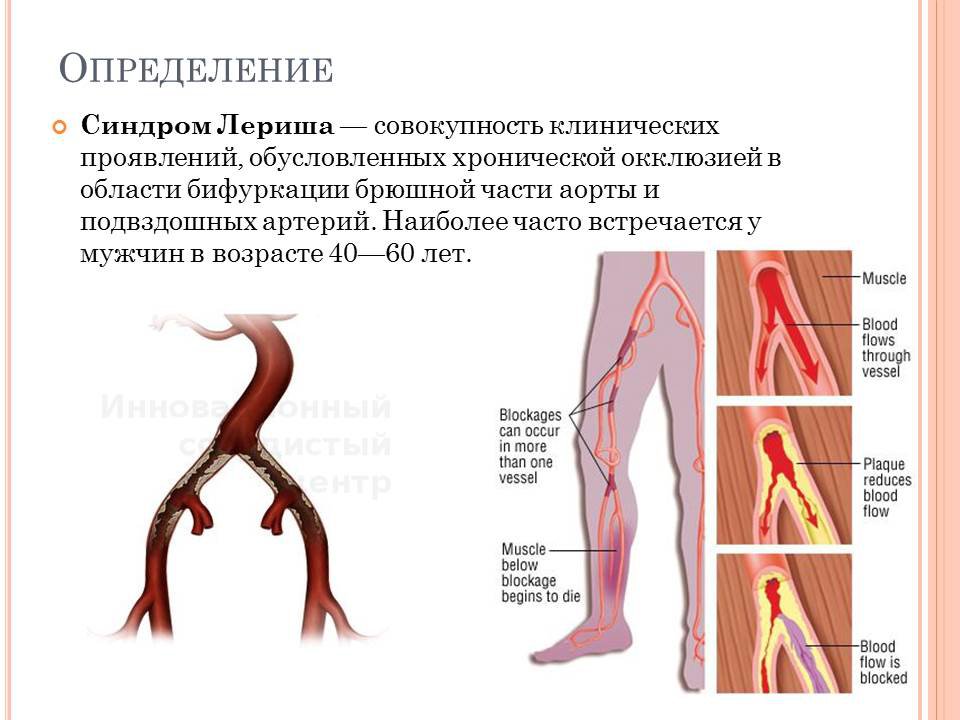 Тромбоз подвздошных вен. Атеросклеротическое поражение артерий. Атеросклероз бедренной артерии. Реконструктивные операции при атеросклеротическом поражении аорты. Атеросклероз подвздошных артерий патогенез.