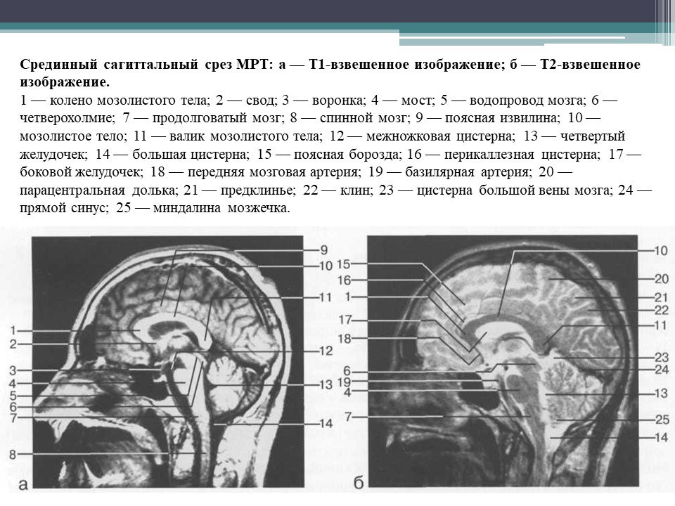 Гипоплазия правого поперечного синуса. Анатомия головного мозга мрт сагиттальные срезы. Анатомия мозолистого тела головного мозга мрт. Мрт головного мозга фронтальный срез. Сагиттальный срез мозга кт.