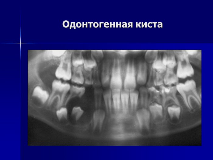 Презентация - периодонтит временных зубов