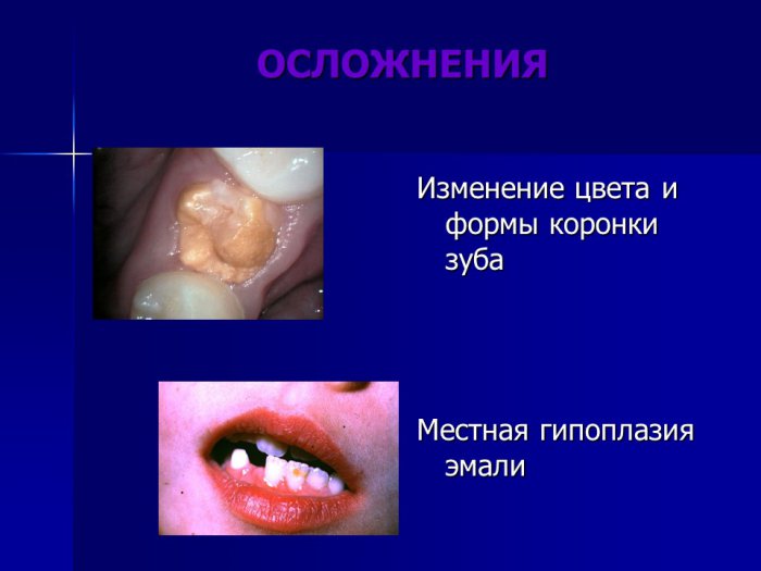 Презентация - периодонтит временных зубов